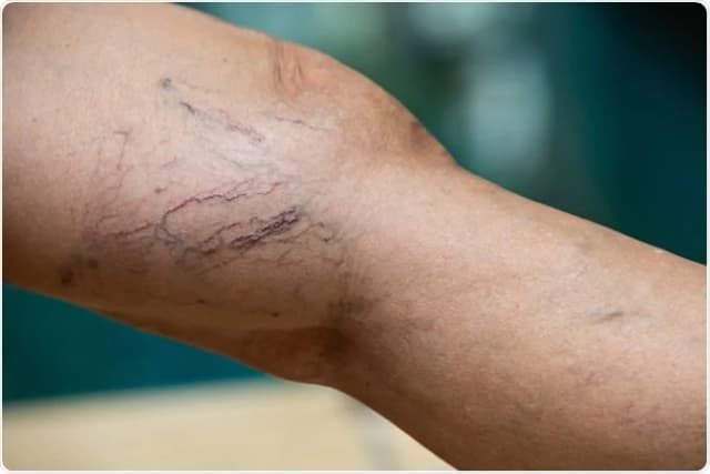 Varicose veins and venous insufficiency treatment, Yonkers NY