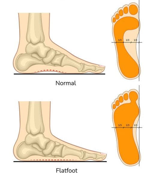 Flat feet symptoms, Yonkers NY