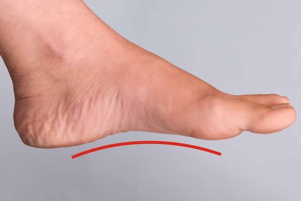 Flat Feet