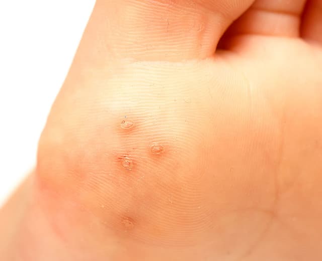Plantar wart on foot, Yonkers NY