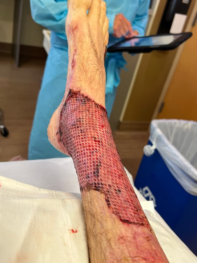 Foot wound graft procedure in Yonkers, NY