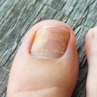 Close-up of fungal toenail, Yonkers NY
