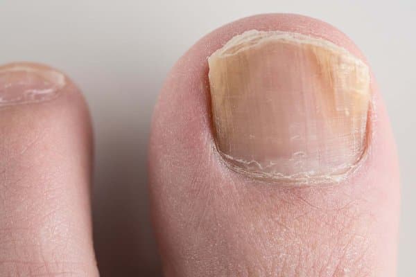 Fungal Toenails