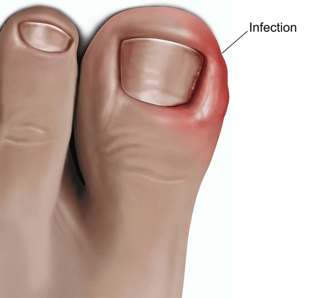 Close-up of an ingrown toenail