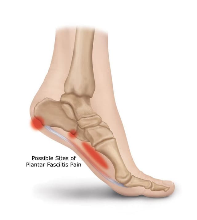 Plantar fasciitis symptoms, Yonkers NY