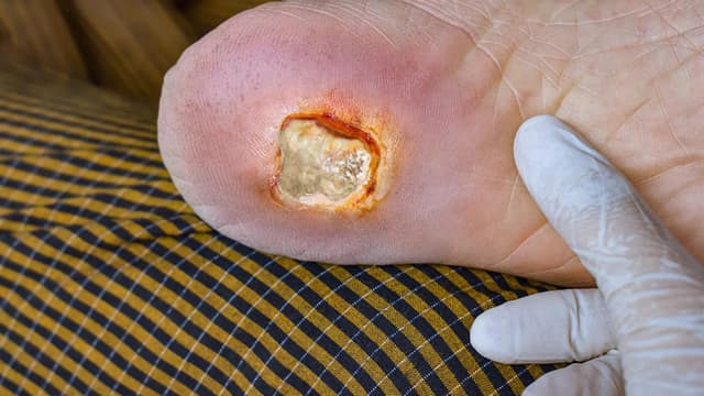 Diabetic foot ulcer requiring care, Yonkers NY