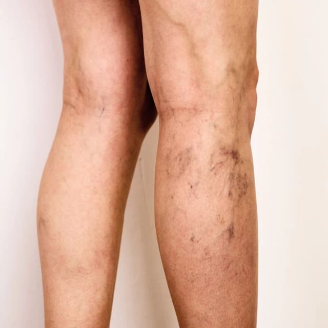 Varicose veins and leg swelling clinical photo
