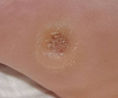 Close-up of plantar wart, Yonkers NY