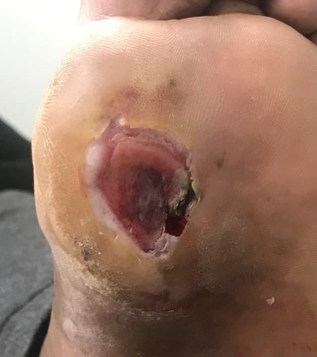 Diabetic foot ulcer clinical photo