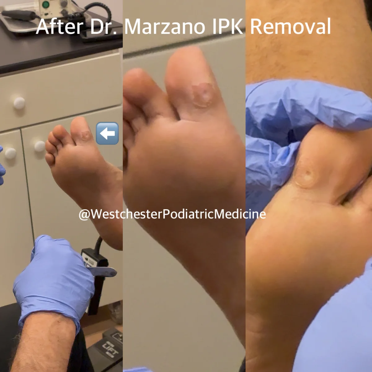 Before and after photos of a deep, painful callus (IPK) removed by Dr. Marzano