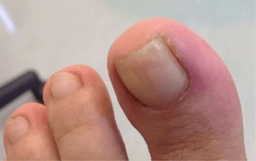 Ingrown toenail causing pain, Yonkers NY