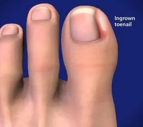 Illustration of an ingrown toenail on the big toe