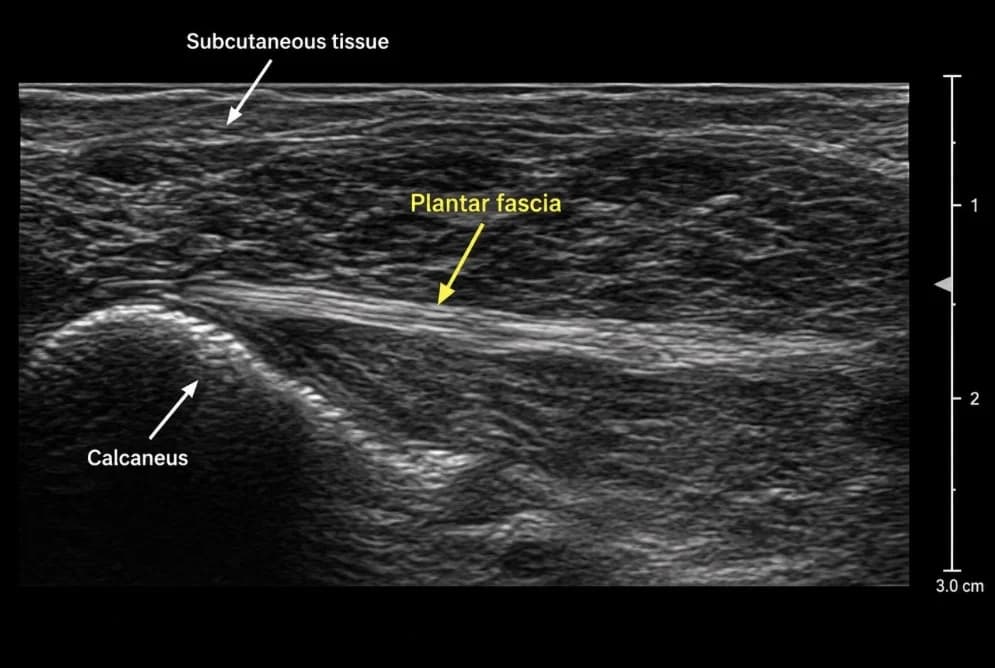 A diagnostic ultrasound image of the heel showing the plantar fascia